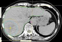 Specifying Tumor Shape