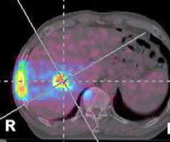 PET Image and CT Image Matching